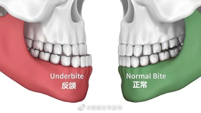 吃饭总咬腮帮子可能是咬合问题