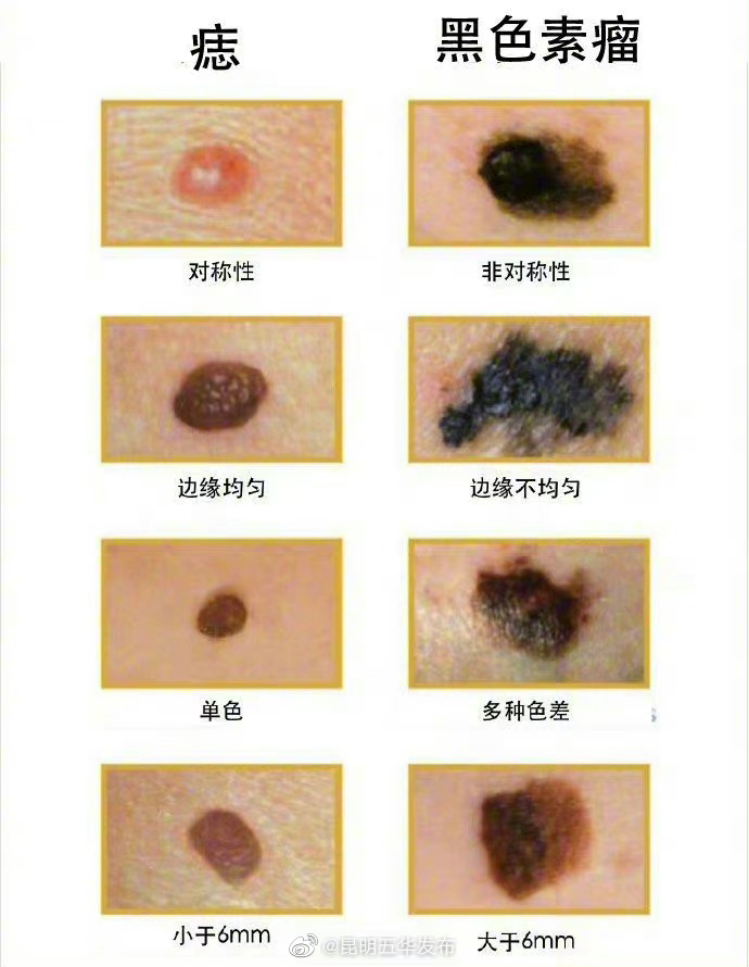 长什么样的痣容易癌变?