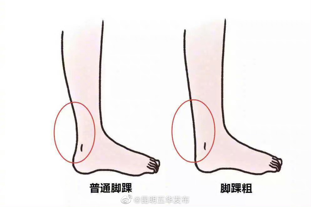 说一个脚脖子粗的好处：跟腱更健康