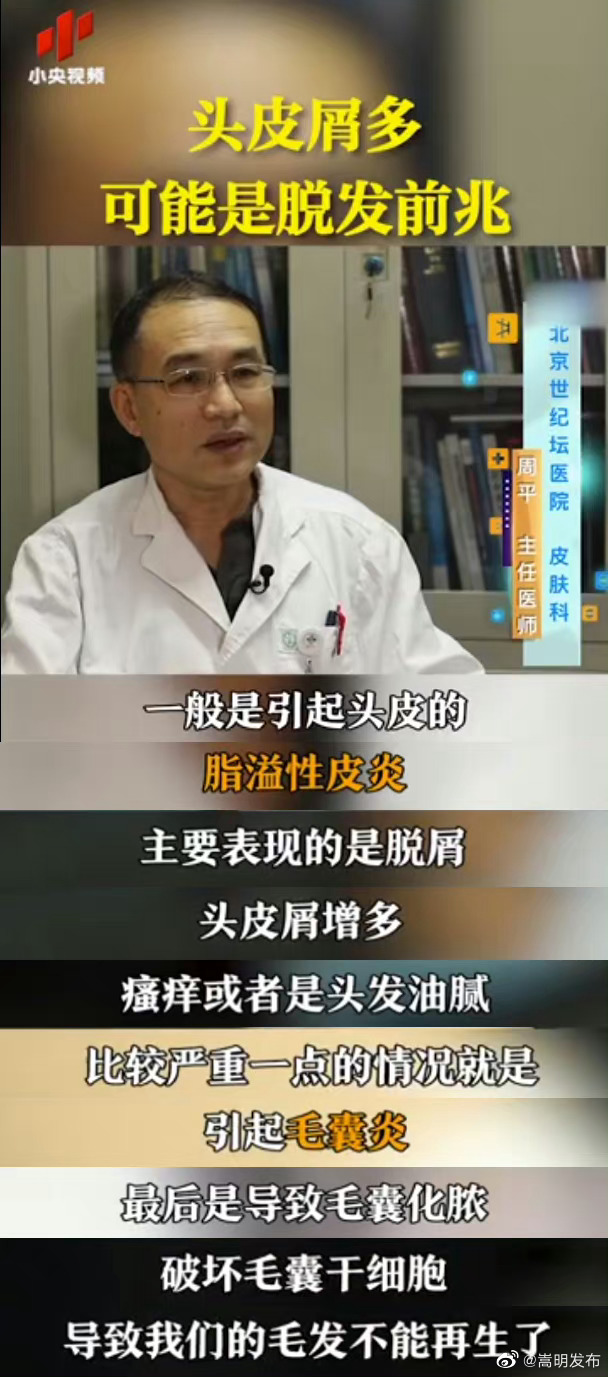 头屑多可能是脱发前兆