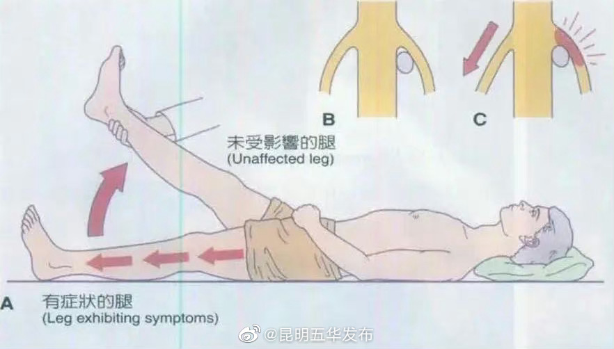 一个试验判断是否腰突