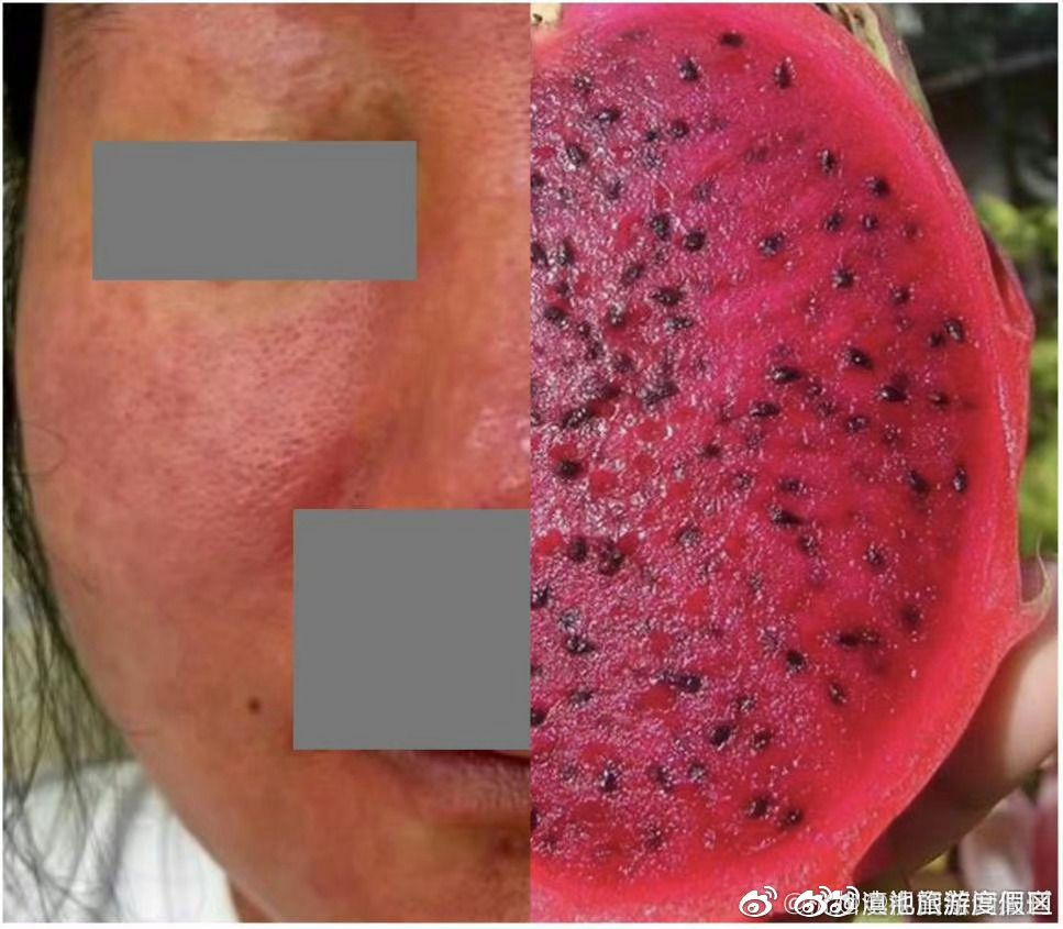 杭州女子养仓鼠脸烂成火龙果 养宠物要弄明白来历