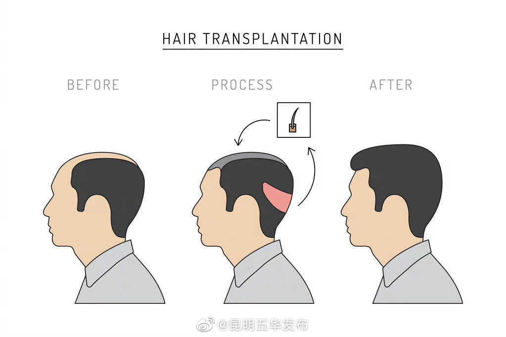 植发就是拆东墙补西墙