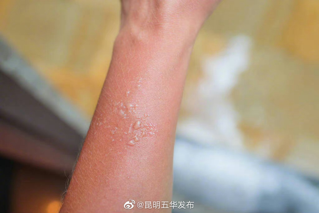 烧烫伤越疼病情反而越轻