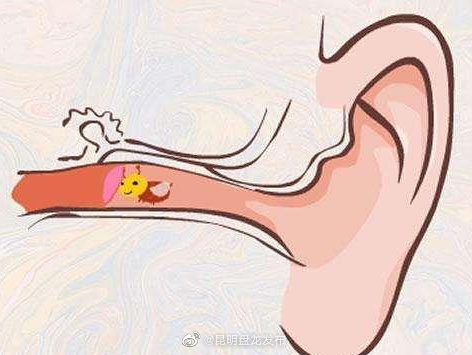 蚊虫不慎入耳滴点油