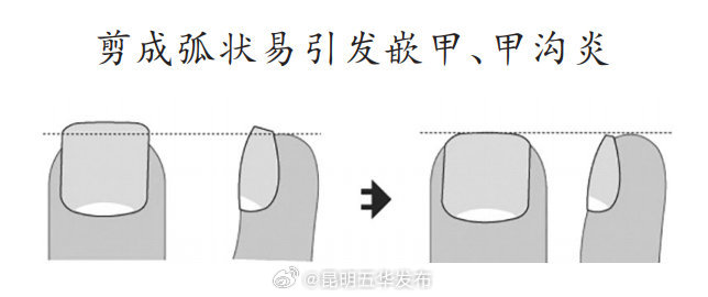 指甲剪太短易患甲沟炎