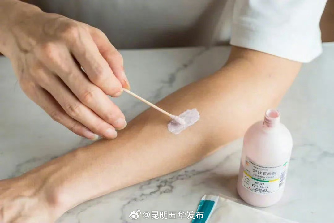 用炉甘石洗剂就能对付蚊子包