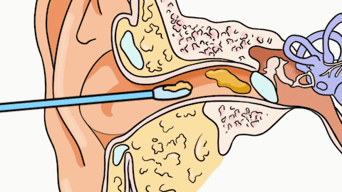 总掏耳朵耳屎可能越来越多