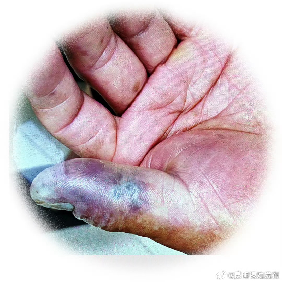 男子洗小龙虾被扎伤吃了消炎药仍去世,医生:患者感染了维隆气单胞菌