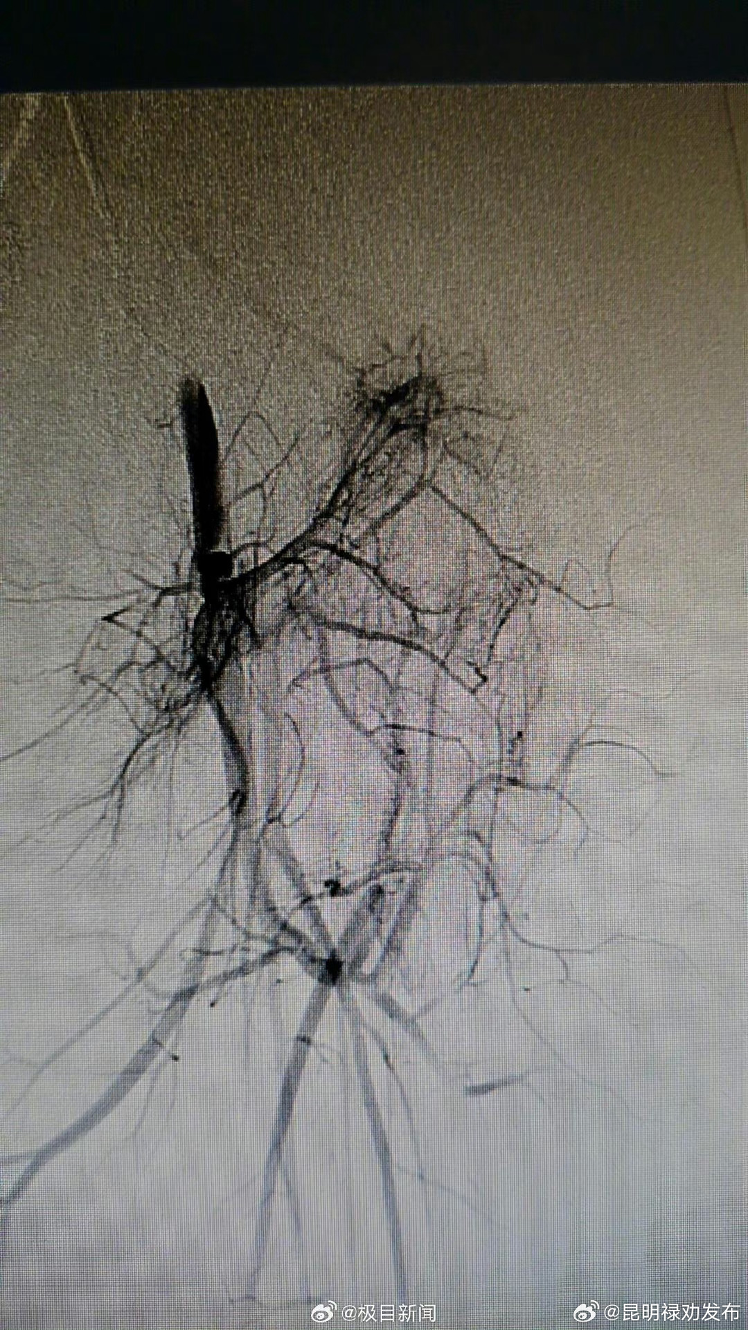 7岁女孩胎记不仅发烫还会跳动！