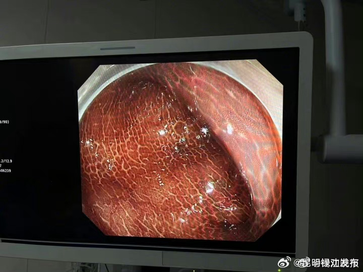 便秘后乱吃药女子肠子黑得像蛇皮