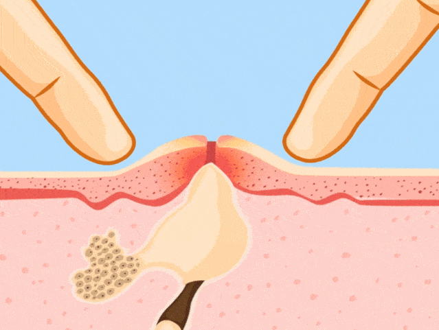 痘痘为什么会氧化变黑 