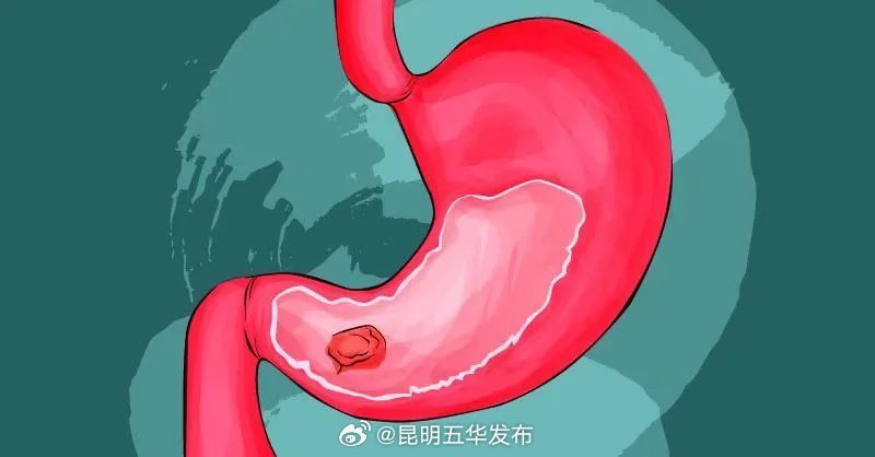 胃里长这种息肉不易得胃癌