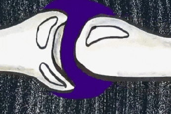 4个症状提示半月板损伤