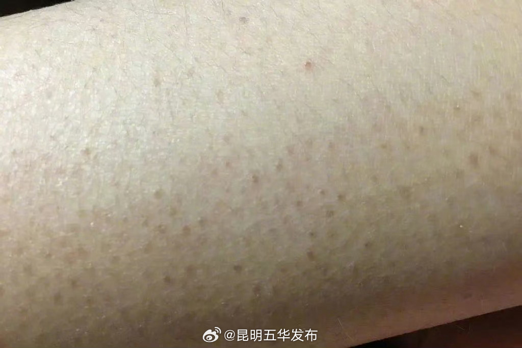 鸡皮肤部位不要用手挠