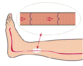 人体最容易藏血栓的部位：下肢