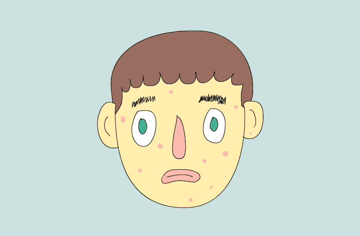 不同部位长痘各有病根