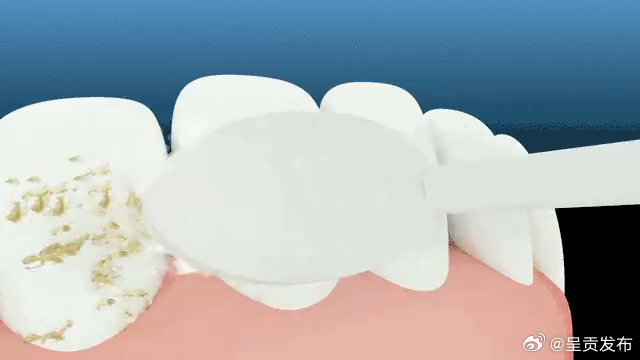 5个信号提示牙菌斑过多 