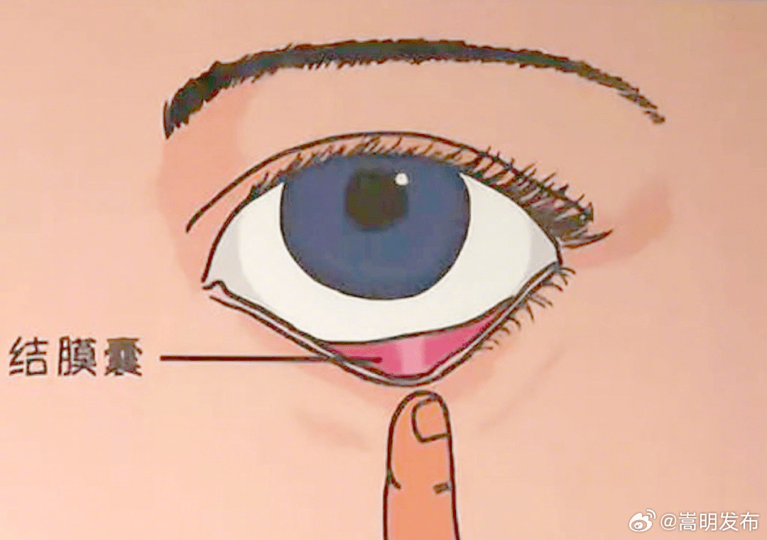 掉进眼睛里的睫毛最后去哪了