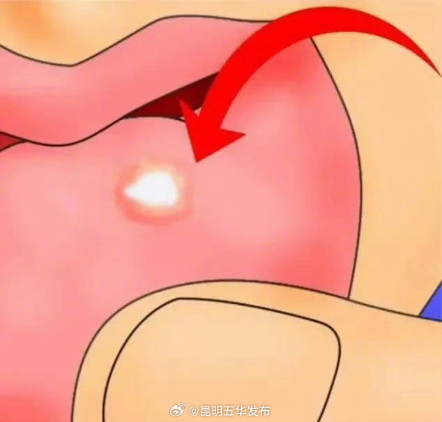 这种口腔溃疡可能是癌前病变