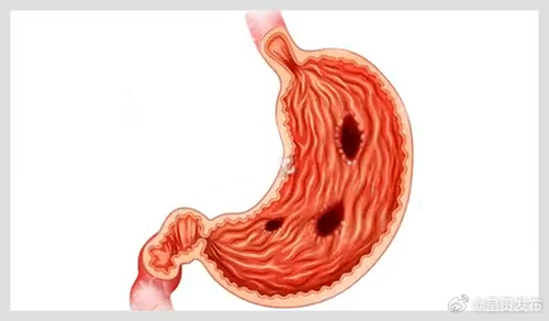 顽固性口臭可能是幽螺感染