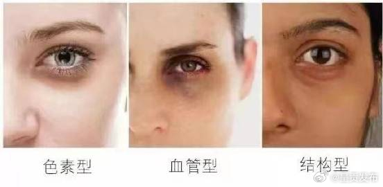 你的黑眼圈是哪种类型 