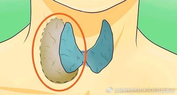 甲状腺结节患者有多少患上甲状腺癌 