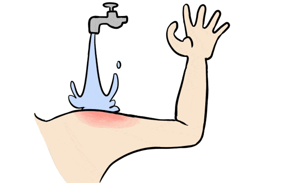 烧烫伤后2小时是黄金急救时间