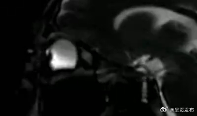 核磁共振还原揉眼睛全过程