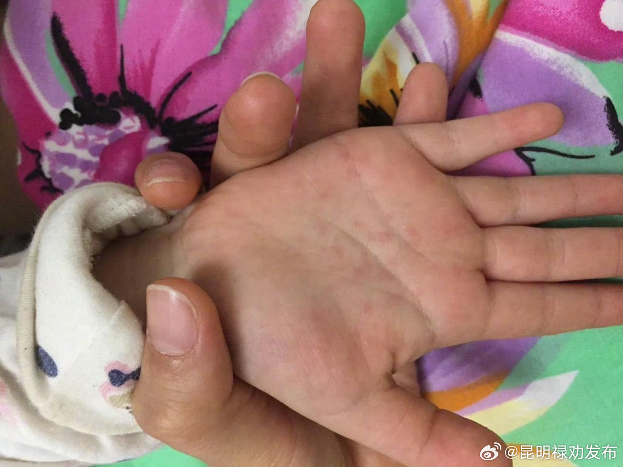 中疾控：与重症手足口病相关病毒有暴发风险