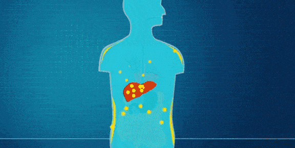 瘦人得脂肪肝后更易肝硬化