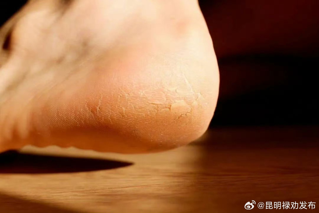 脚后跟干裂可能是感染了脚气