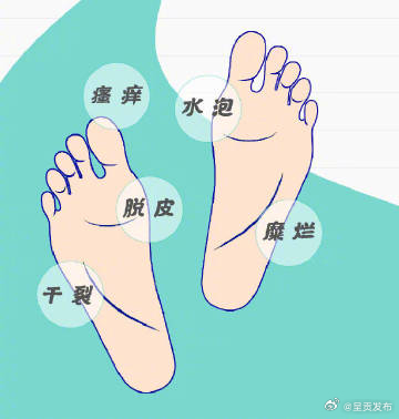 不是所有脚气都会脚臭