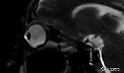 眼睛里进异物千万不要揉