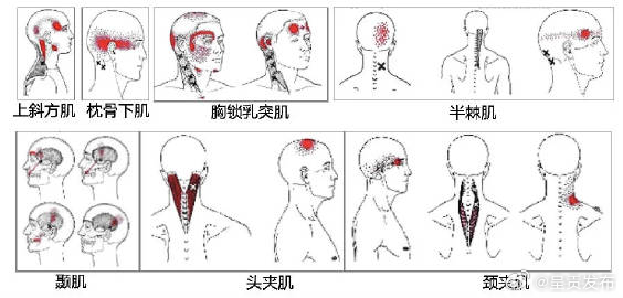 八成头痛是颈椎引起的