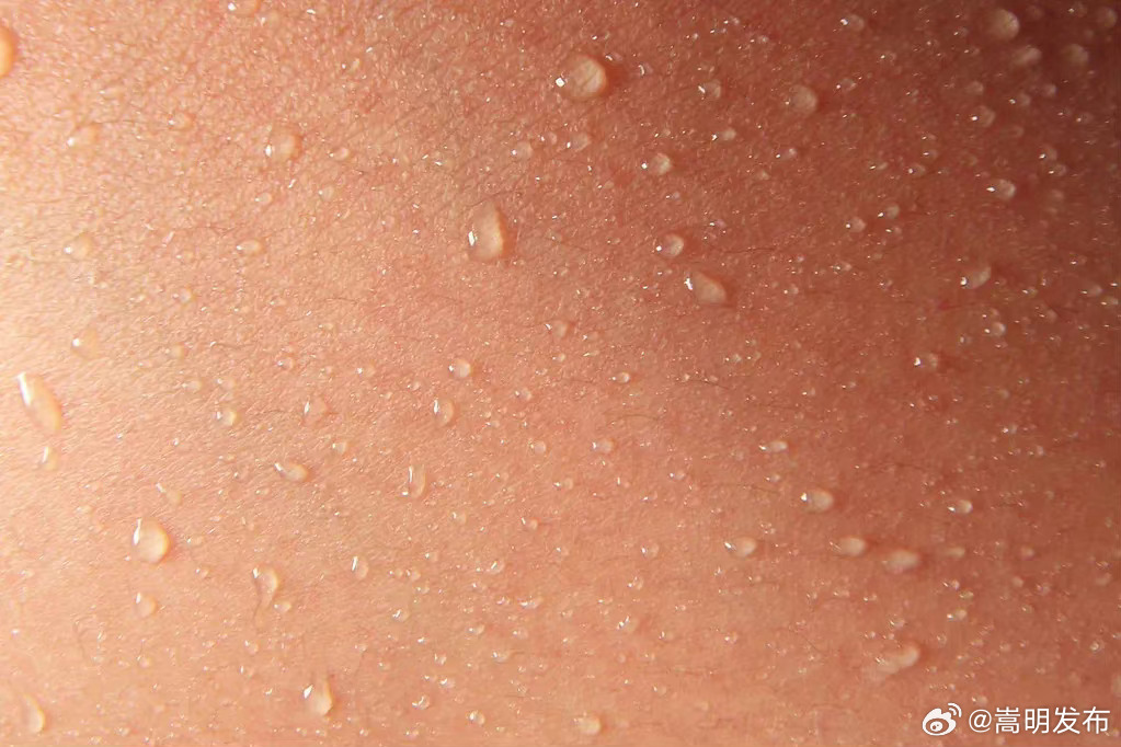 有一种出汗是疾病信号