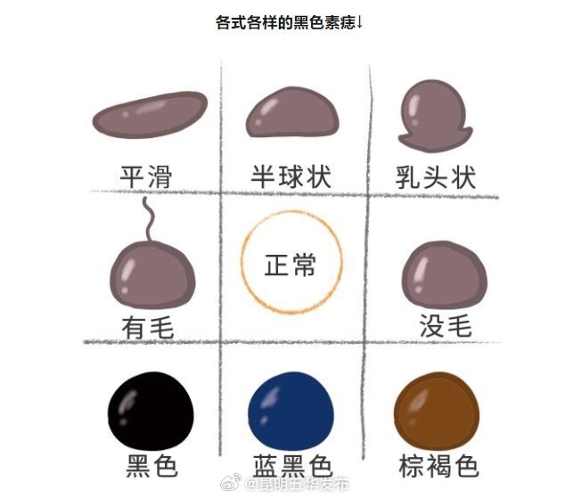 医生提醒4个做法加速黑痣癌变 