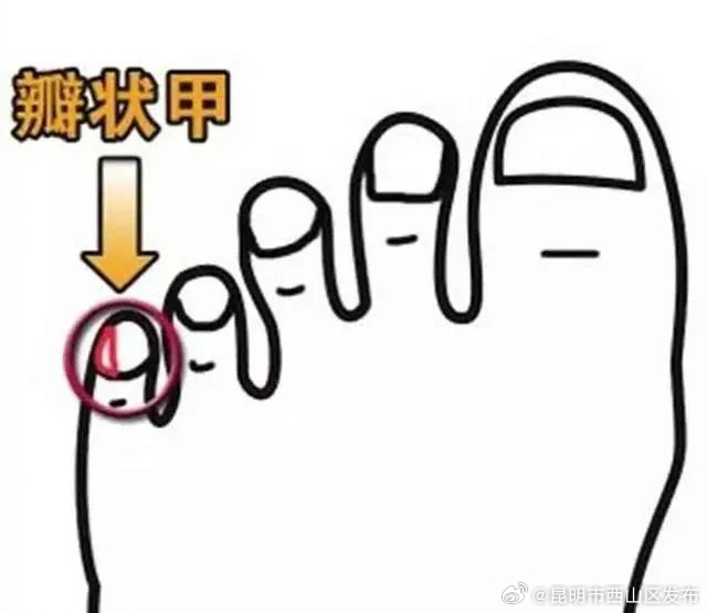 小脚趾的趾甲为啥是两瓣