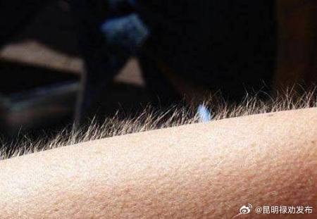 皮肤突然长白毛或是癌症征兆