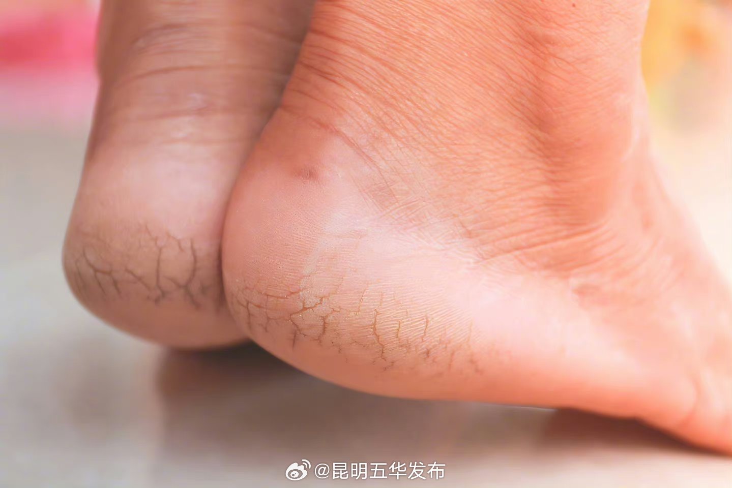 脚跟干裂排查一下4种病
