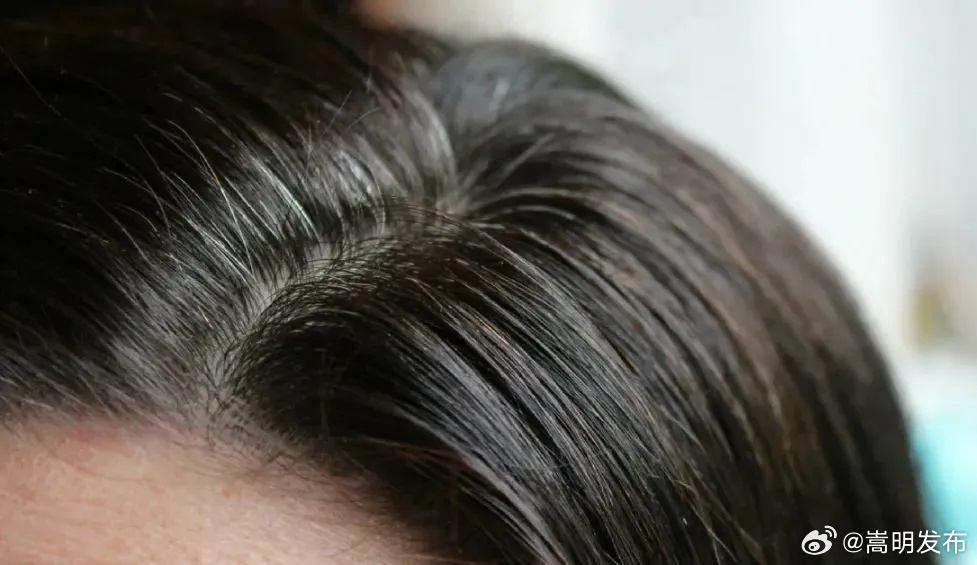 头发白了还能自己黑回去吗 