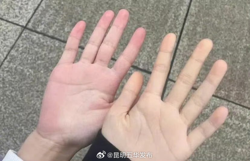 3种皮肤变化建议查查血