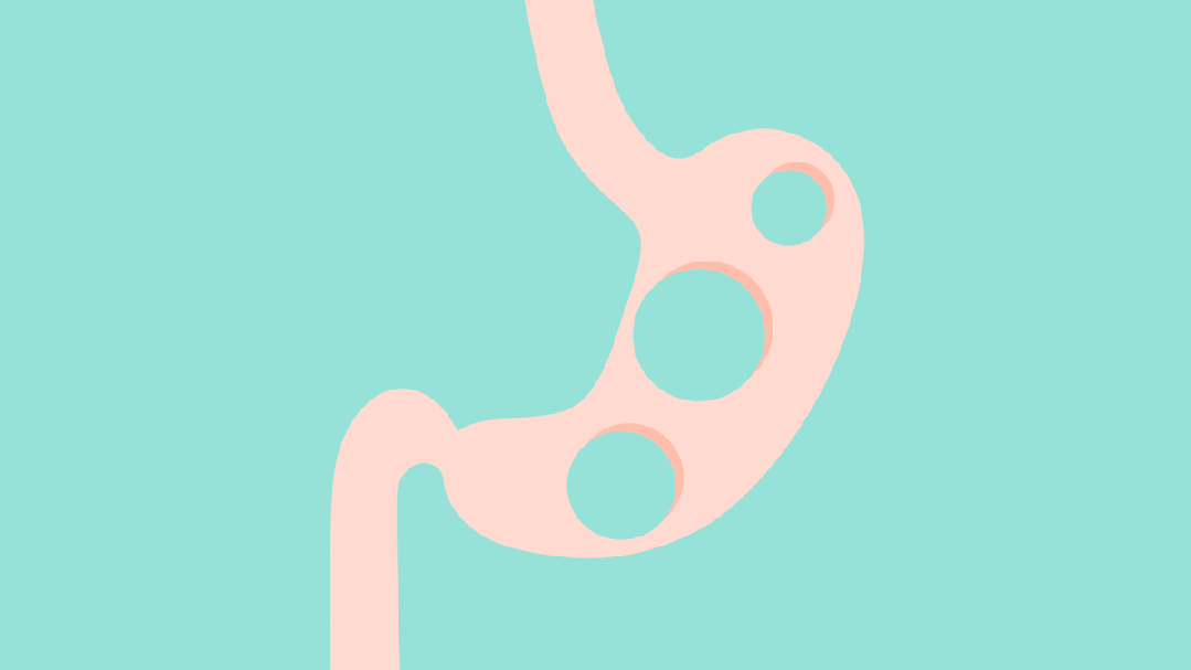 空腹吃6种食物可能吃出胃结石