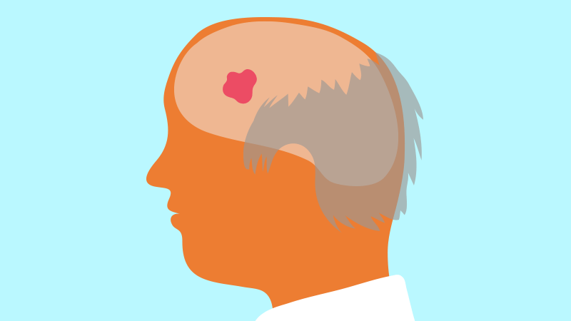 暴怒后两小时脑卒中风险增3倍