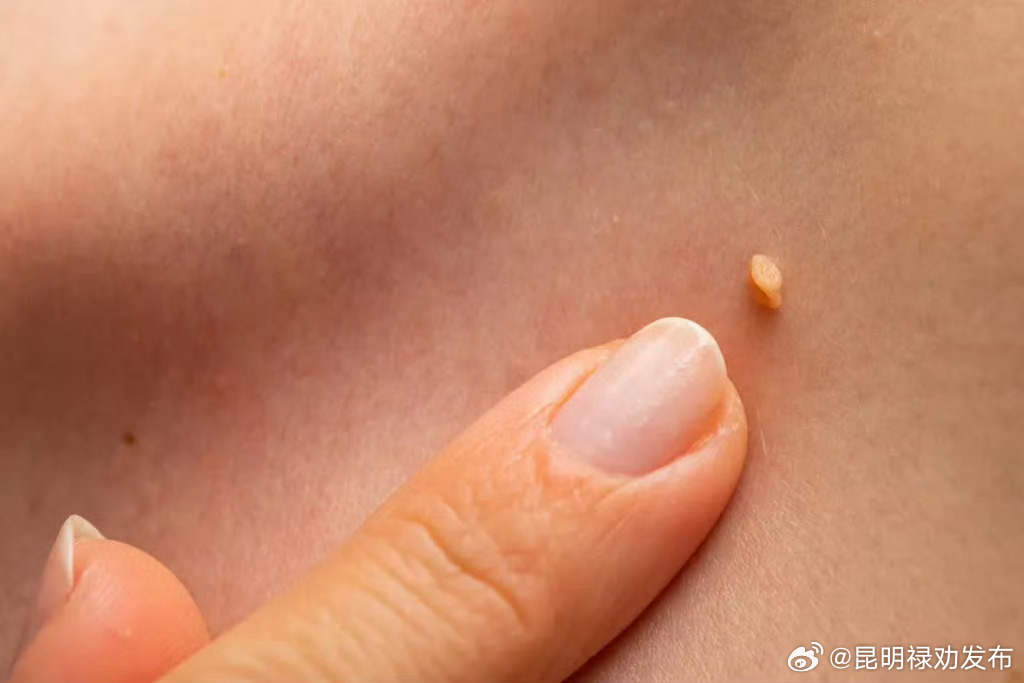 脖子上的小肉粒是什么