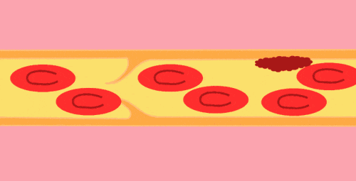 血栓最容易堵在身体3个部位