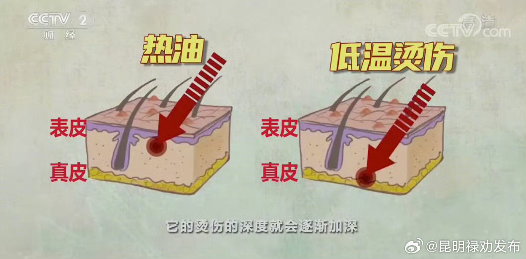 44℃持续6小时就可能出现低温烫伤