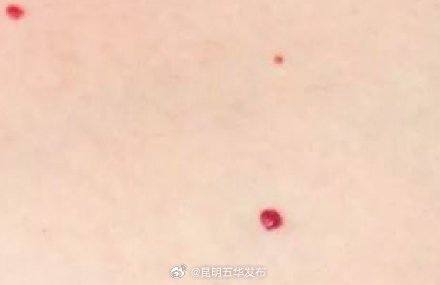 皮肤上的小红点到底是什么