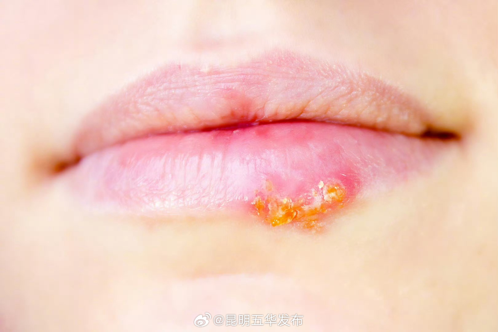 嘴角起泡是种病毒感染